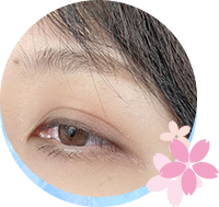 眼瞼下垂とは？